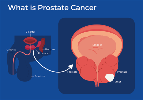 prostate cancer.png